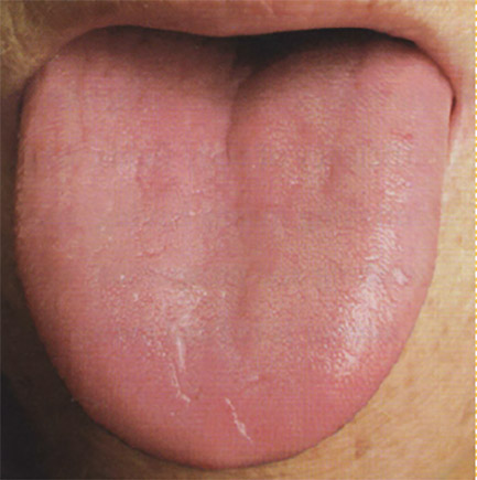 lengua normal