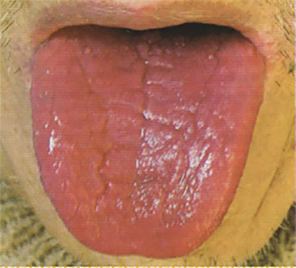 lengua pelada MTC